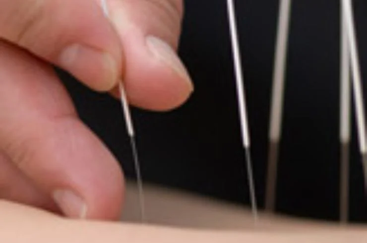 Acupuncture